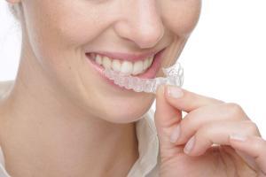 Clear aligner
