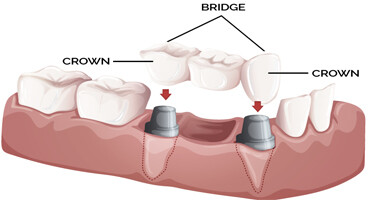 crown-bridge