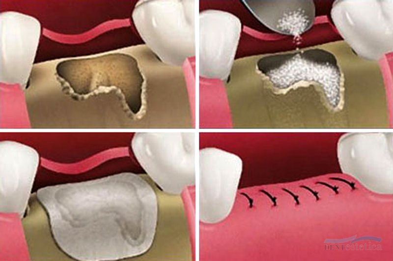 guidedbone