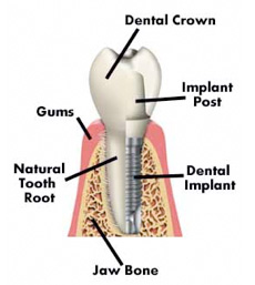 implant_diagram
