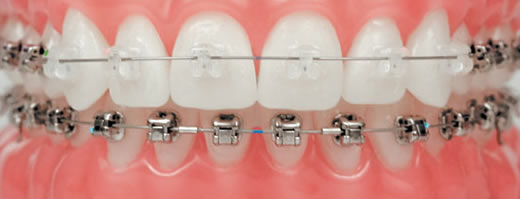 Fixed braces