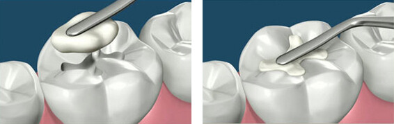 white-fillings-in-watford