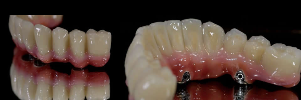 Fixed Teeth in a Day Fixed Implant Bridge