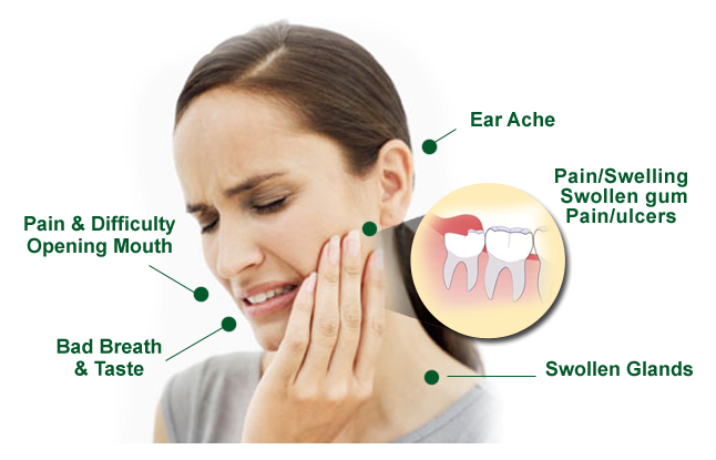 Wisdom-Teeth-Symptoms