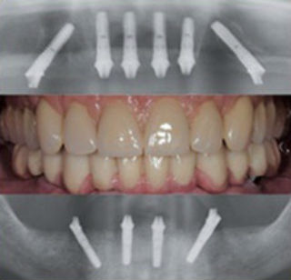 Fixed Teeth in a Day Fast and Fixed teeth