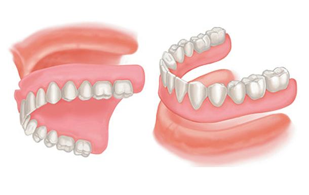 Complete_denture