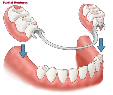 metal-dentures