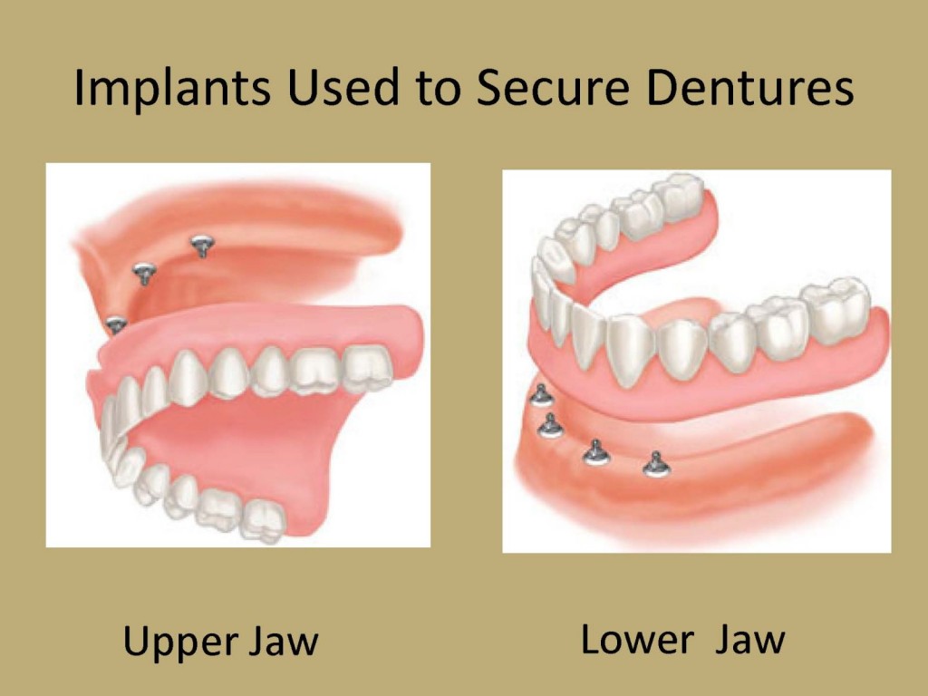 implant overdenture