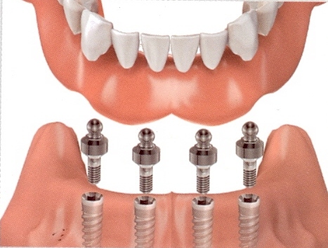 lower overdenture
